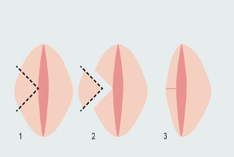 دکتر لابیاپلاستی  - تبریز